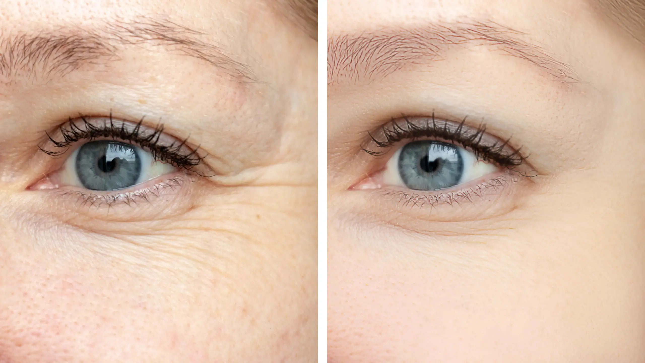 Botox vs Dysport: Which Is Right for You